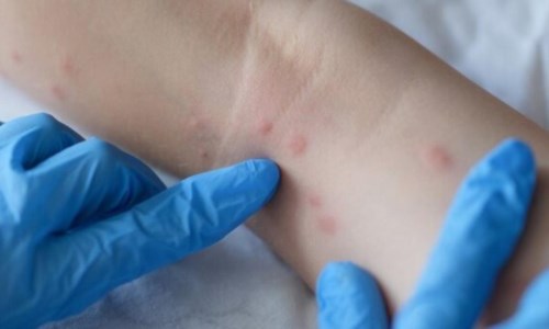 Vaiolo delle ScimmieLa Svizzera valuta l’acquisto di un vaccino contro la malattia