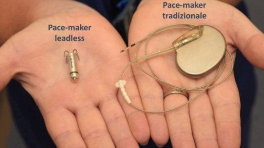 Nuove tecnologieCardiologia, a Crotone impiantati con successo pacemaker senza fili