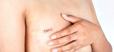 Cancro, per i pazienti oncologici a Lamezia tatuaggi paramedicali gratis