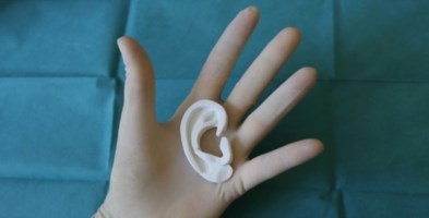 Ricostruito orecchio a 13enne grazie alla stampa 3D: era nato senza 