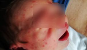 Mamme e neonati assaliti da nugoli di zanzare. L'ospedale di Lamezia come una giungla